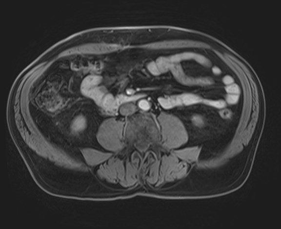 Cecal mass causing appendicitis (Radiopaedia 59207-66532 H 79).jpg