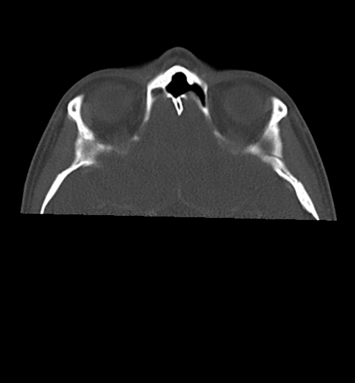 File:Cemento-ossifying fibroma (Radiopaedia 46243-50643 Axial bone window 14).png