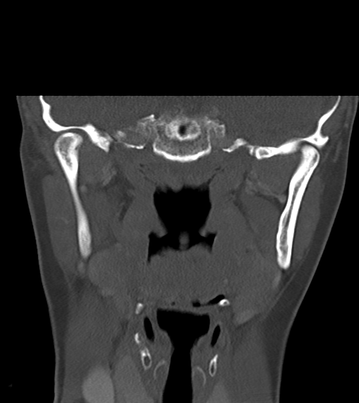 Cemento-ossifying fibroma (Radiopaedia 46243-50643 Coronal bone window 36).png