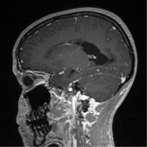 Central neurocytoma (Radiopaedia 37664-39557 Sagittal T1 C+ 63).png