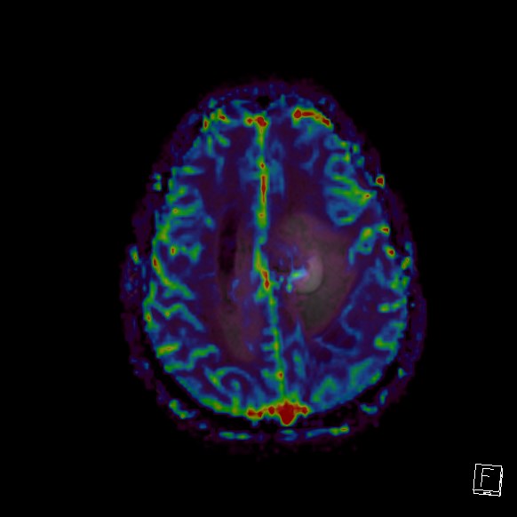 Central neurocytoma (Radiopaedia 84497-99872 Axial Perfusion 81).jpg