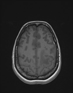 Central neurocytoma (Radiopaedia 84497-99872 Axial T1 153).jpg