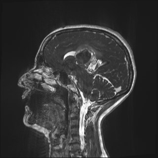 Central neurocytoma (Radiopaedia 84497-99872 Sagittal CISS 52).jpg