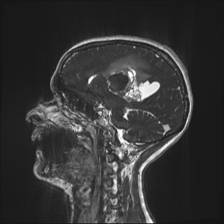Central neurocytoma (Radiopaedia 84497-99872 Sagittal CISS 58).jpg