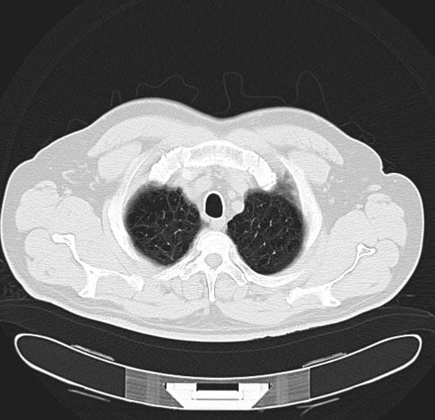 Centrilobular pulmonary emphysema (Radiopaedia 26808-26971 C 5).jpg