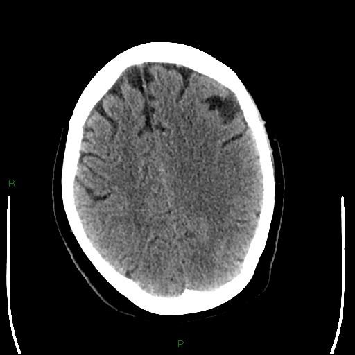 Cerebellar abscess (Radiopaedia 78135-90671 Axial non-contrast 76).jpg