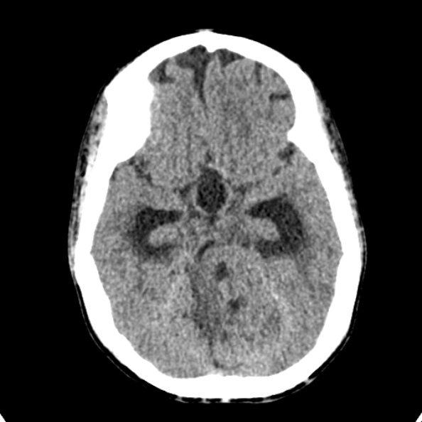 File:Cerebellar abscess secondary to mastoiditis (Radiopaedia 26284-26412 Axial non-contrast 58).jpg