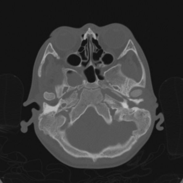 File:Cerebellar abscess secondary to mastoiditis (Radiopaedia 26284-26413 Axial bone window 37).jpg