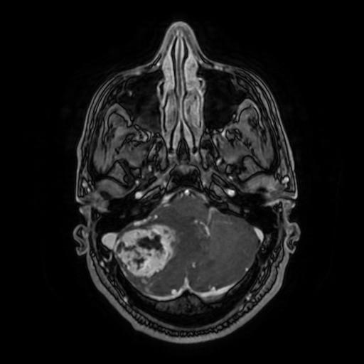 Cerebellar hemangioblastoma (Radiopaedia 88055-104622 Axial T1 C+ 51).jpg