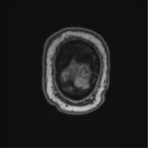 File:Cerebellar hemangioblastomas and pituitary adenoma (Radiopaedia 85490-101176 Coronal T1 10).png