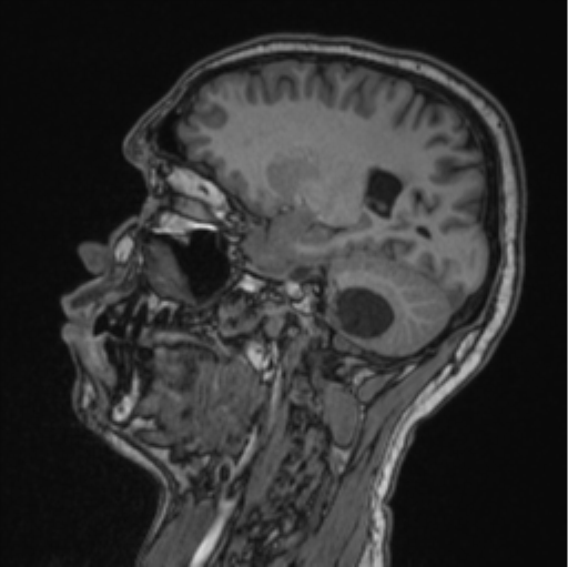 Cerebellar hemangioblastomas and pituitary adenoma (Radiopaedia 85490-101176 Sagittal T1 63).png