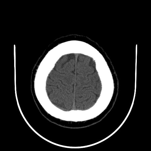 File:Cerebellar infarction (Radiopaedia 16625-16327 Axial non-contrast 33).jpg