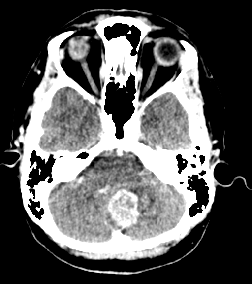 Cerebellar metastases - colorectal adenocarcinoma (Radiopaedia 40947-43652 Axial C+ 11).png