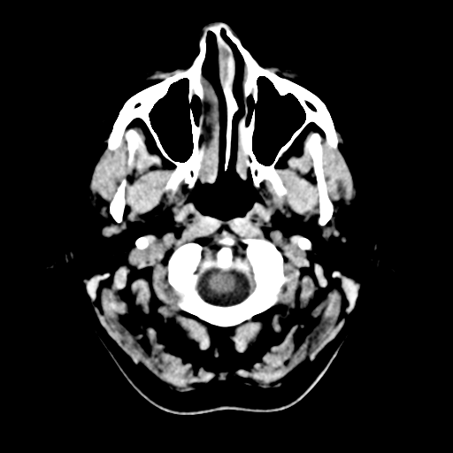 File:Cerebellar metastasis (Radiopaedia 54578-60812 Axial non-contrast 2).png