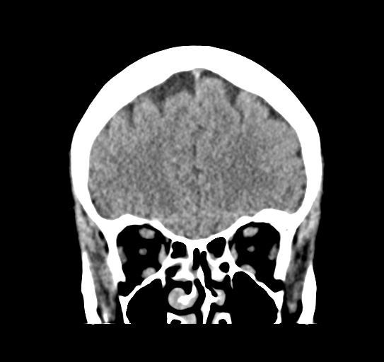 Cerebellar metastasis (Radiopaedia 54578-60812 Coronal non-contrast 13).png