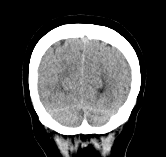 Cerebellar metastasis (Radiopaedia 54578-60812 Coronal non-contrast 52).png