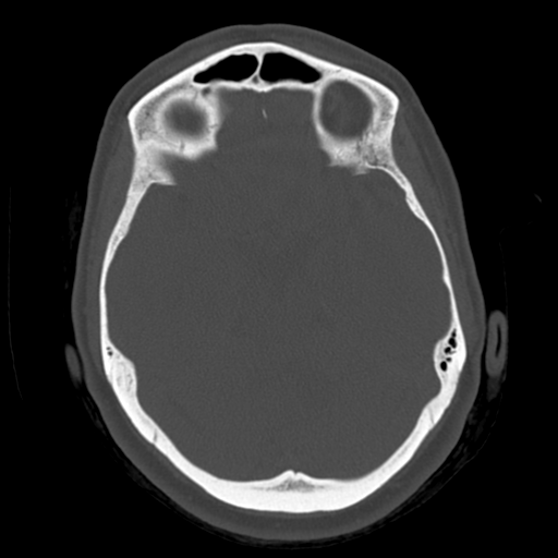 Cerebellar metastasis (cystic appearance) (Radiopaedia 41395-44258 Axial bone window 24).png