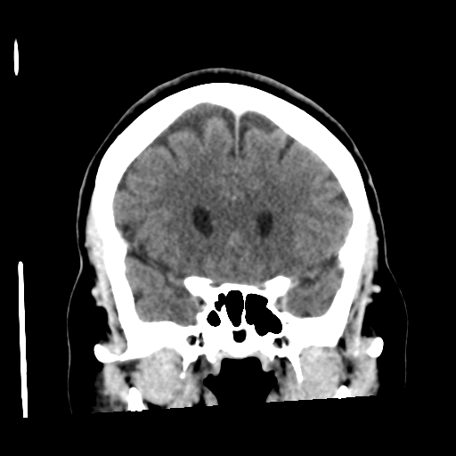 Cerebellar metastasis (cystic appearance) (Radiopaedia 41395-44258 D 23).png