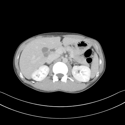 Cerebellar metastasis - adenocarcinoma lung (Radiopaedia 63184-71717 Axial C+ delayed 73).png