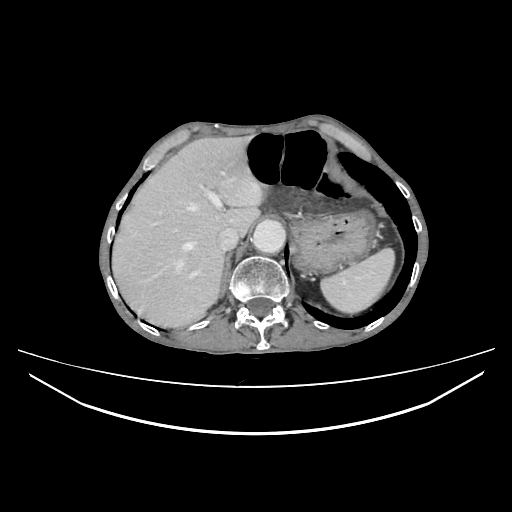 Cerebellar metastasis - lung tumor (Radiopaedia 69317-79150 A 35).jpg