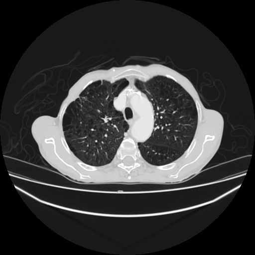 File:Cerebellar metastasis - lung tumor (Radiopaedia 69317-79150 Axial lung window 9).jpg