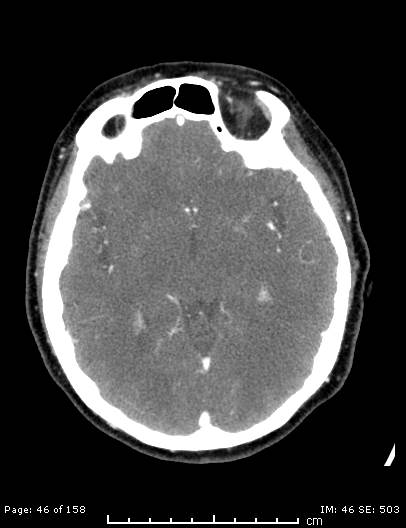 Cerebellar strokes due to intracranial giant cell arteritis (Radiopaedia 68799-78510 CT angiogram 46).jpg