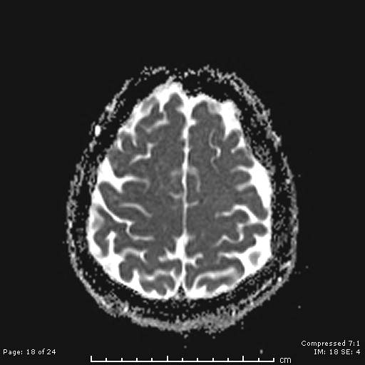 File:Cerebellar strokes due to intracranial giant cell arteritis (Radiopaedia 68799-81713 Axial ADC 18).jpg