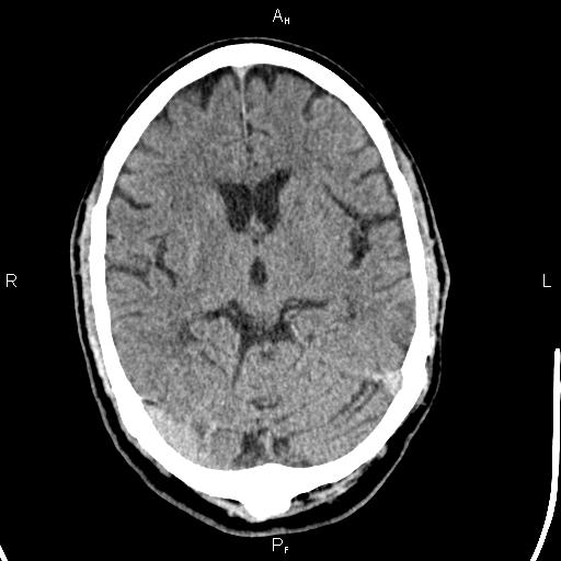 Cerebellopontine angle arachnoid cyst (Radiopaedia 85149-100704 Axial With contrast 23).jpg