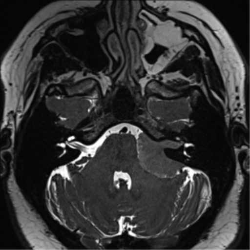Cerebellopontine angle meningioma (Radiopaedia 48434-53348 Axial T2 Space 56).png