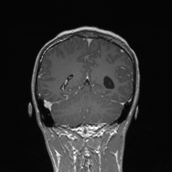 Cerebral abscess (Radiopaedia 24212-24478 Coronal T1 C+ 148).jpg