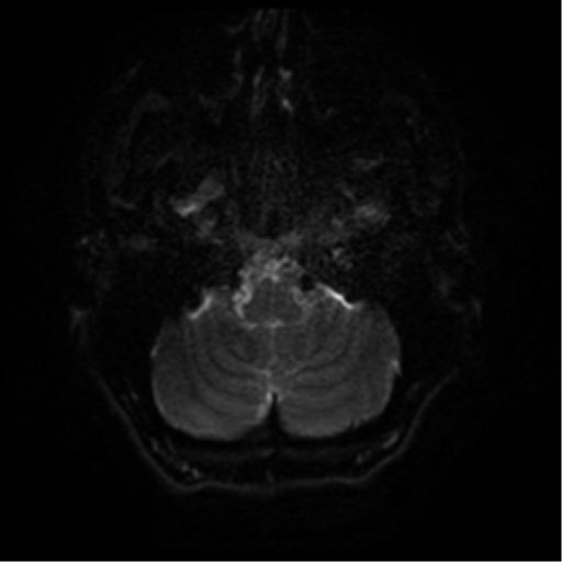 File:Cerebral abscess (Radiopaedia 57774-64740 Axial DWI 33).png