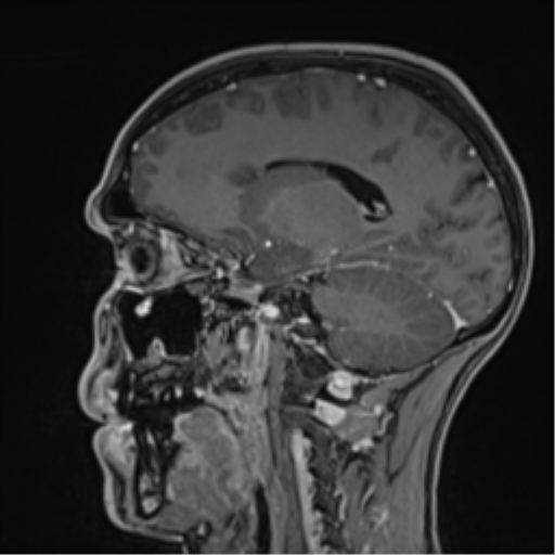 Cerebral abscess (Radiopaedia 60342-68009 J 24).png