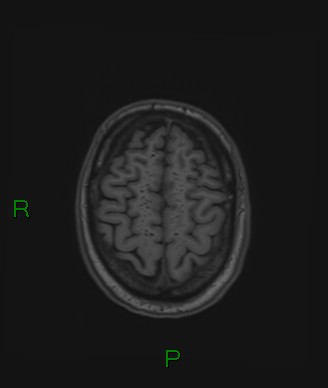File:Cerebral abscess and subdural empyema (Radiopaedia 84436-99779 Axial T1 19).jpg