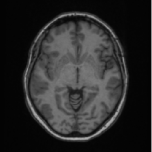 Cerebral abscess from pulmonary arteriovenous malformation (Radiopaedia 86275-102291 Axial T1 36).png