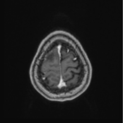 Cerebral abscess from pulmonary arteriovenous malformation (Radiopaedia 86275-102291 Axial T1 C+ 68).png