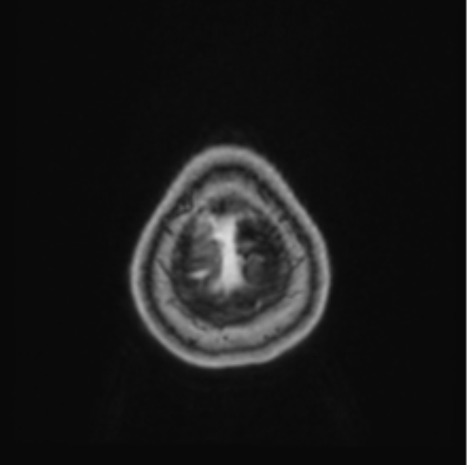 Cerebral abscess from pulmonary arteriovenous malformation (Radiopaedia 86275-102291 Axial T1 C+ 72).png