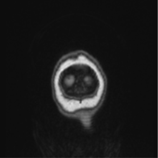 File:Cerebral abscess from pulmonary arteriovenous malformation (Radiopaedia 86275-102291 Coronal T1 5).png