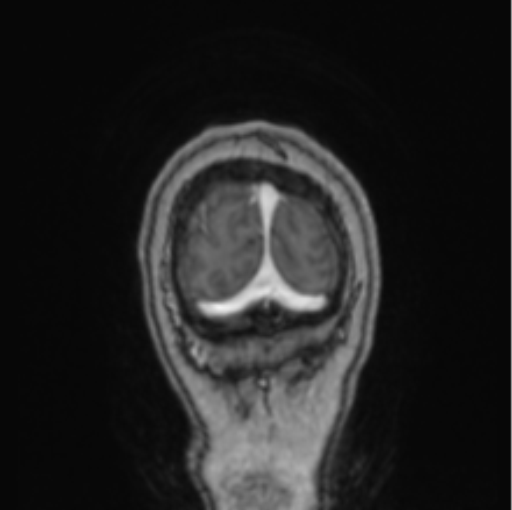 Cerebral abscess from pulmonary arteriovenous malformation (Radiopaedia 86275-102291 L 10).png