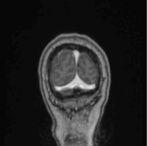 Cerebral abscess from pulmonary arteriovenous malformation (Radiopaedia 86275-102291 L 11).png