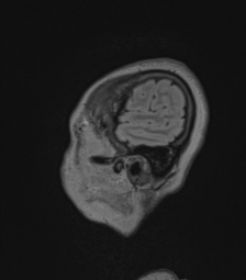 Cerebral abscess from pulmonary arteriovenous malformation (Radiopaedia 86275-102291 Sagittal FLAIR 67).png