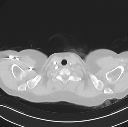 File:Cerebral abscess from pulmonary arteriovenous malformation (Radiopaedia 86275-102292 Axial lung window 4).png