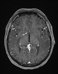 Cerebral amyloid angiopathy-related inflammation (Radiopaedia 58270-65377 Axial T1 C+ fat sat 66).jpg