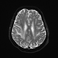 Cerebral amyloid angiopathy-related inflammation (Radiopaedia 74836-85849 Axial DWI 20).jpg