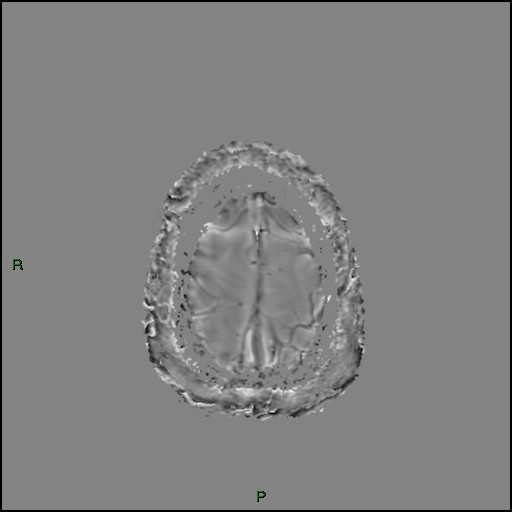 Cerebral amyloid angiopathy (Radiopaedia 77506-89664 H 94).jpg