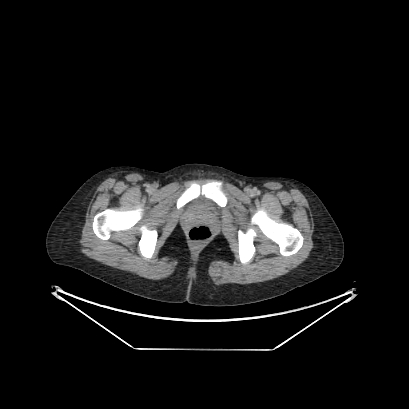 File:Cerebral and abdominal tuberculosis (PET-CT) (Radiopaedia 90499-107853 Axial 62).jpg