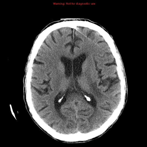 File:Cerebral and orbital tuberculomas (Radiopaedia 13308-13310 Axial non-contrast 35).jpg