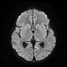 File:Cerebral and spinal tuberculosis (Radiopaedia 90489-107837 Axial DWI 12).jpg