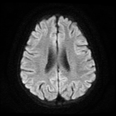 File:Cerebral and spinal tuberculosis (Radiopaedia 90489-107837 Axial DWI 15).jpg