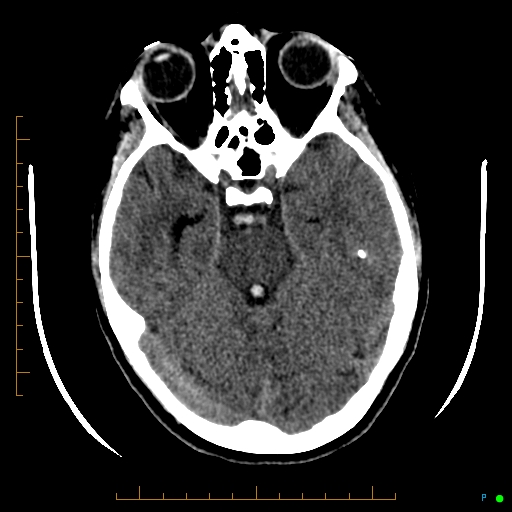 Cerebral arteriovenous malformation (AVM) (Radiopaedia 78162-90706 Axial non-contrast 23).jpg