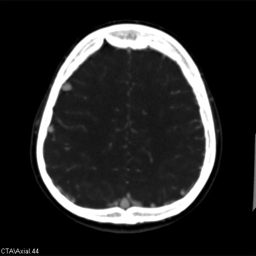 Cerebral arteriovenous malformation (Radiopaedia 28518-28759 B 44).jpg